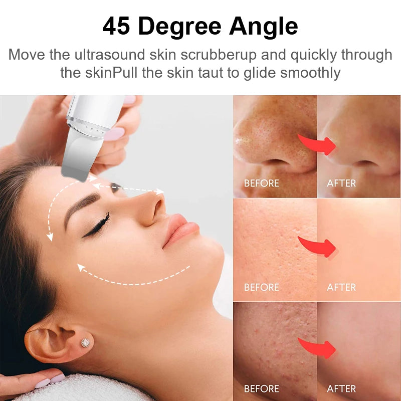 Ultrasonic Skin Facial Shovel Blackhead Cleaner - BeautyAddictsClub